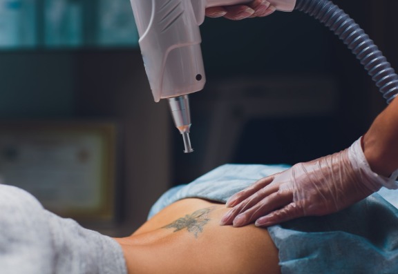 Solving pre-wedding tattoo worries