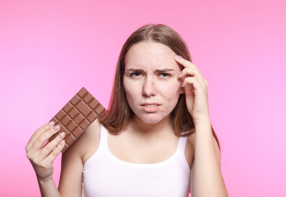 The Myth of Chocolate and Acne
