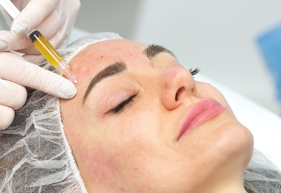 What Is a Vampire Facial? What Is a Vampire Facial?