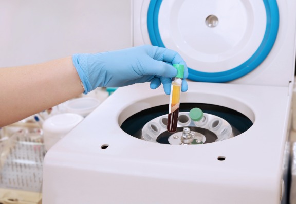 Platelet-Rich Plasma (PRP) therapy