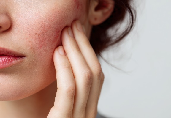 What Skin Concerns Do Chemical Peels Address?