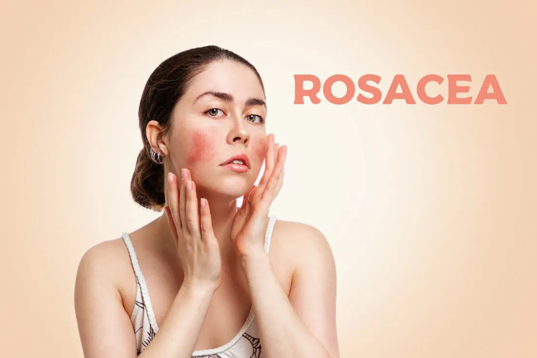 Rosacea in 2026: Understanding Your Options and Where LDM® Triple Fits