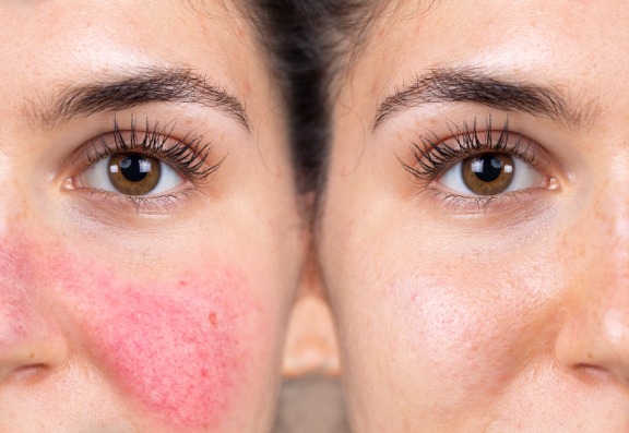 Best treatment for facial veins