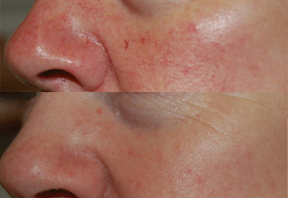 Laser and light based treatments for facial veins