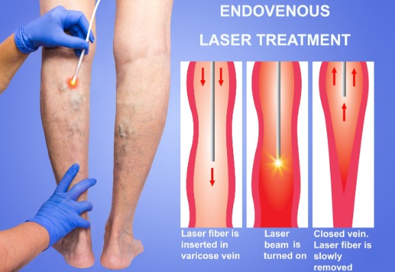 Varicose vein treatment