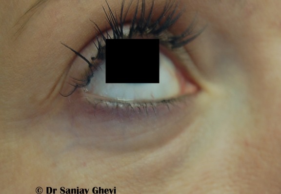 Tear trough treatments