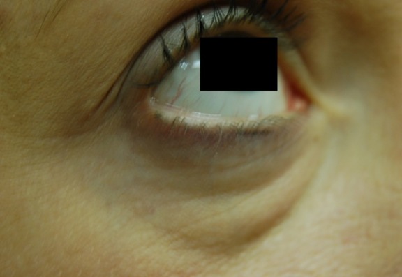 Tear trough treatments
