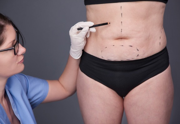 Tummy-tuck treatment