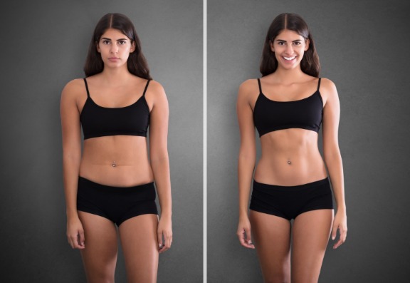 How effective are Lipoabdominoplasty treatments