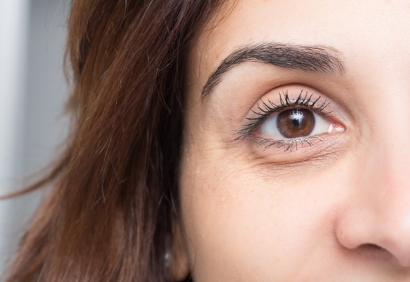 Causes of dark under eye circles
