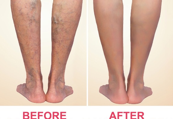 Sapheon Venaseal Superglue for Varicose Veins