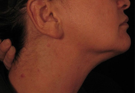 Rash Caused by a Vitamin B12