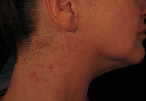 Rash Caused by a Vitamin B12