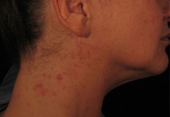Vitamin B12 Deficiency And Skin Rashes Infoupdate