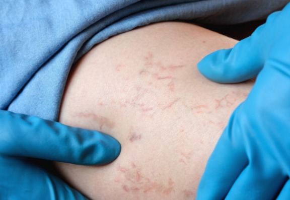 things you didn`t know about varicose veins