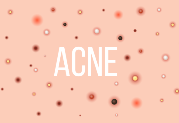 Acne trial shows improvement using light therapy