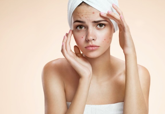 Treatment for Acne