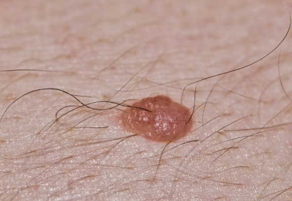 Hairy Moles FAQs