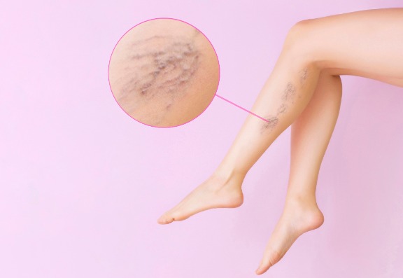 Varicose Vein Treatments