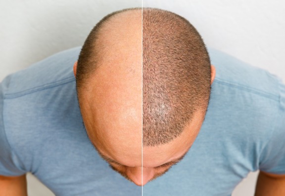 How effective are hair transplant treatments