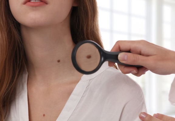 How to treat skin tags
