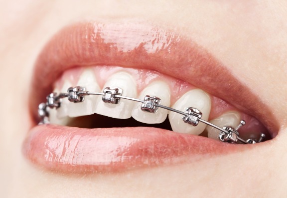 best braces for adults available