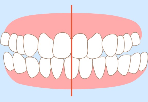 How to straighten your smile