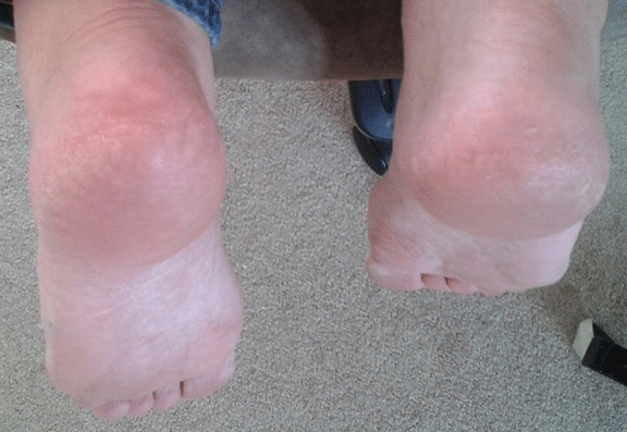 Before and after foot treatments