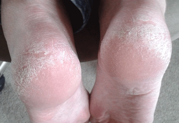 Before and after foot treatments