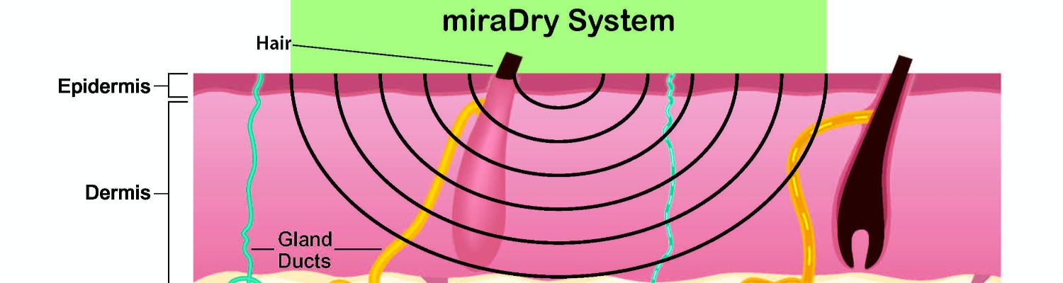 miradry image arm