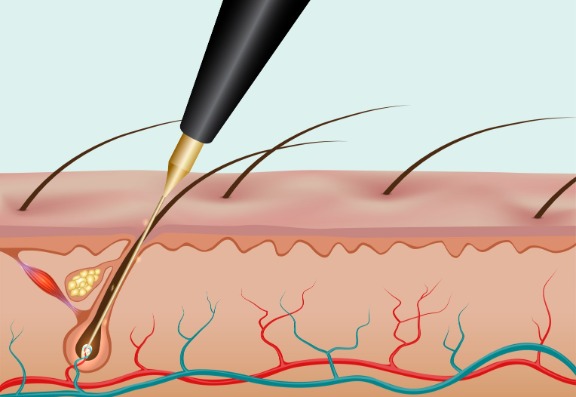 what is Electrolysis treatment?