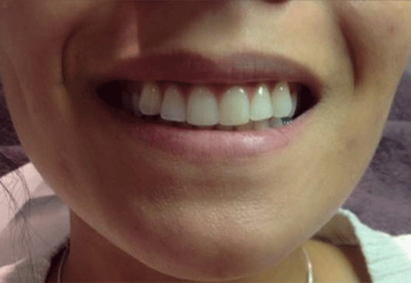 Gummy smile before and after botox