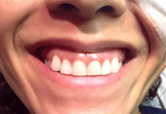 Gummy smile before and after botox