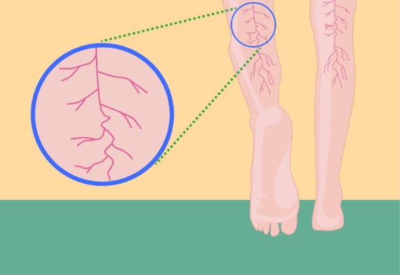 The cause of varicose veins