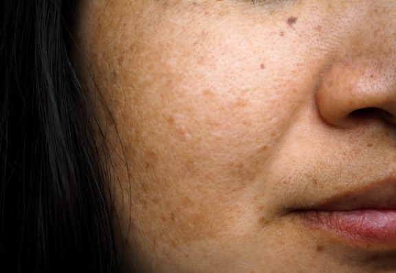 Can melasma be treated?
