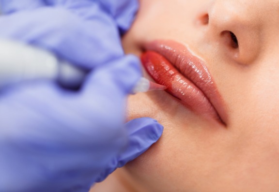 What is microneedling?