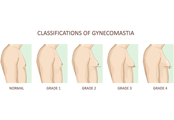 What are the different grades of gynaecomastia?