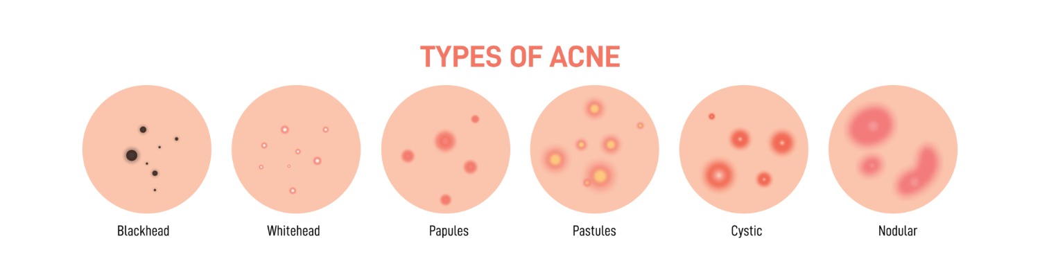 Types of Acne