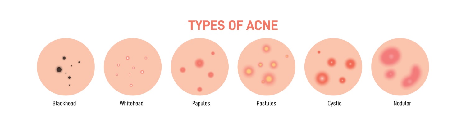 Types of Acne