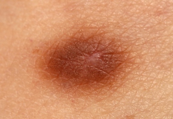 What is Dermatofibromas?