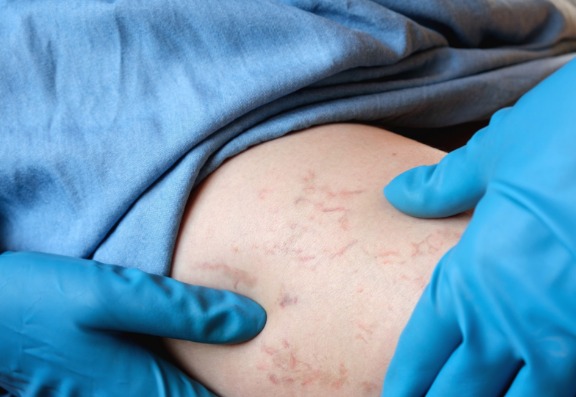 Effectiveness of varicose vein treatment
