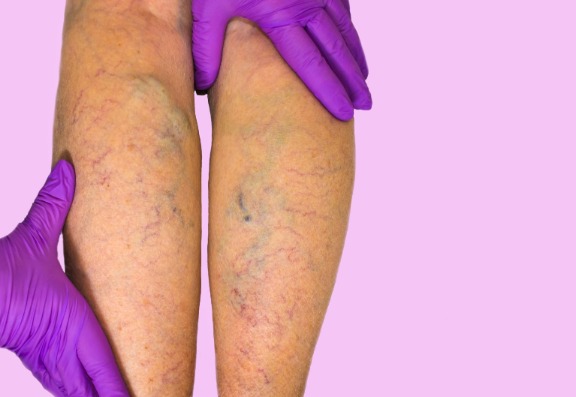 Varicose vein treatment