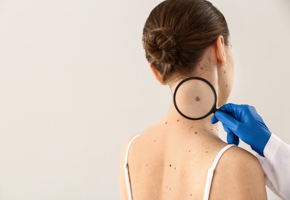 Importance of checking moles