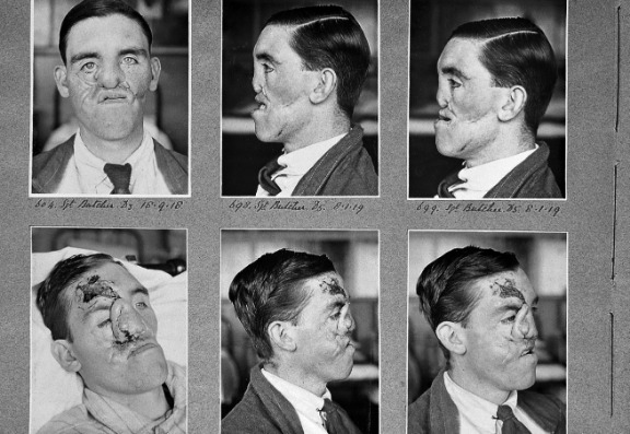 How cosmetic surgery started in ww1