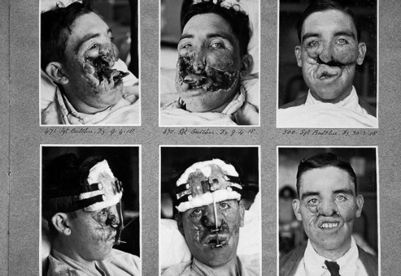 How cosmetic surgery started in ww1