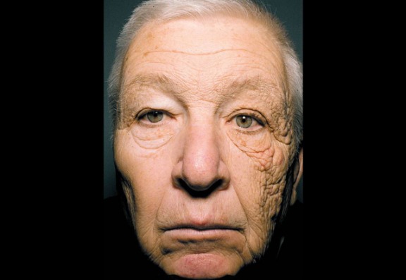 Premature skin ageing from sunlight