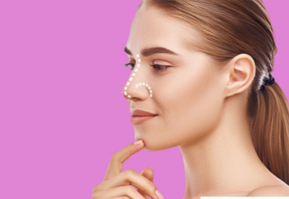 How is rhinoplasty performed