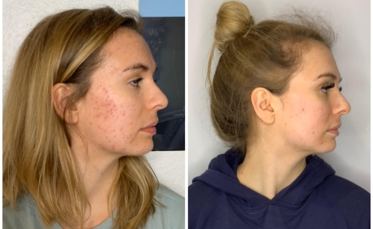 HydraFacial Acne treatment Kenilworth