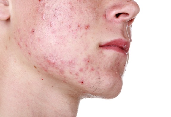 Acne Bacteria