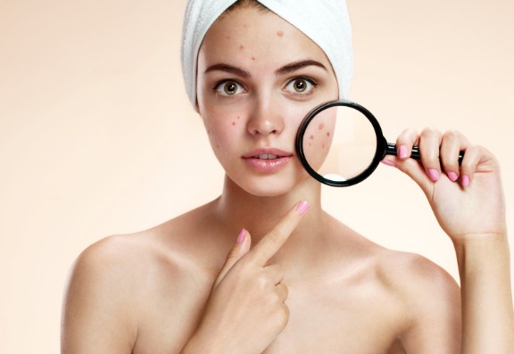treating Acne